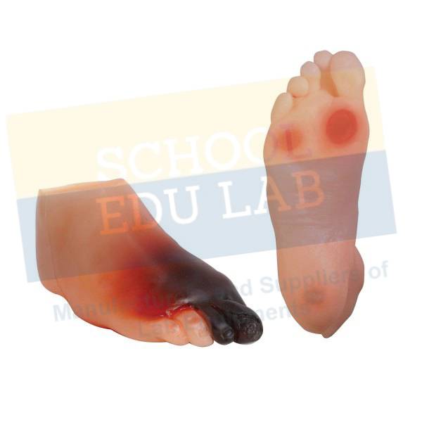 Diabetic Foot Model